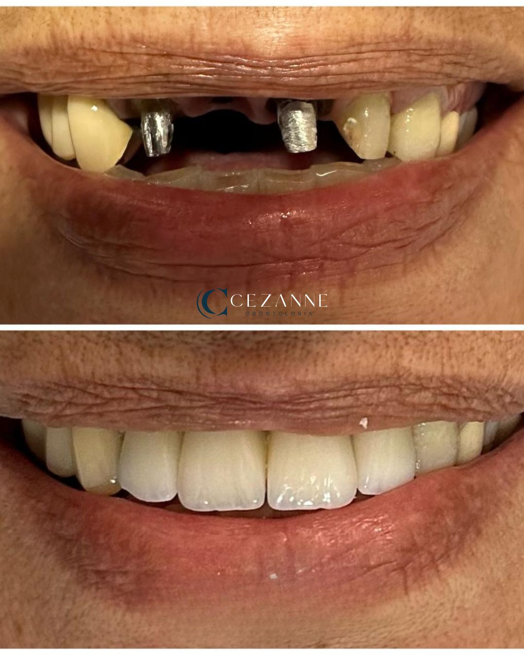 Caso clínico de implante dentário 4