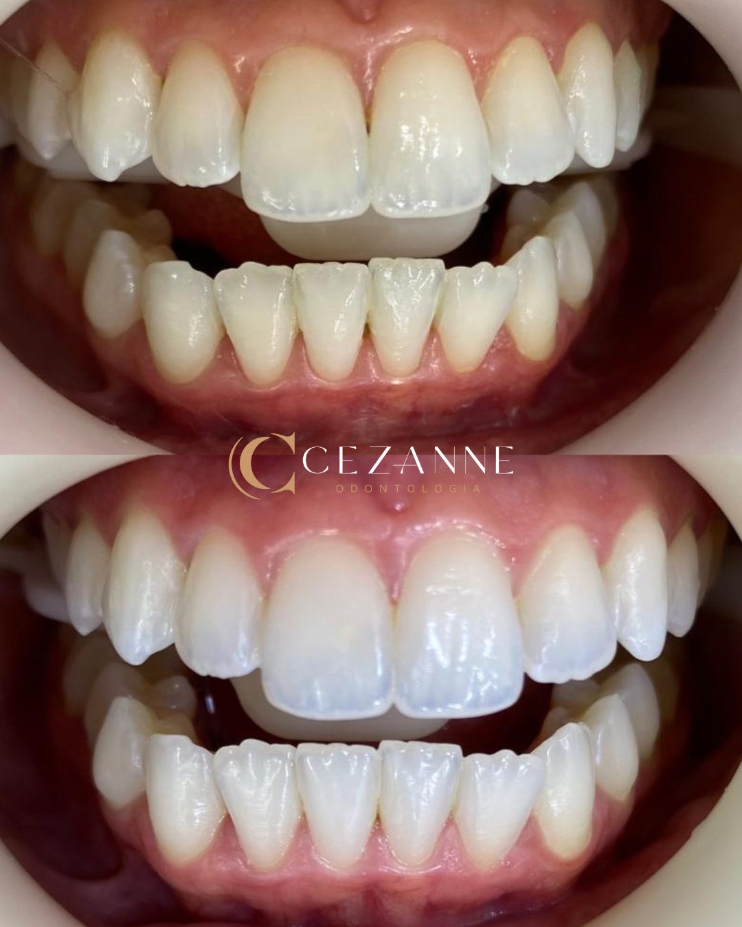 Caso clínico de implante dentário 7