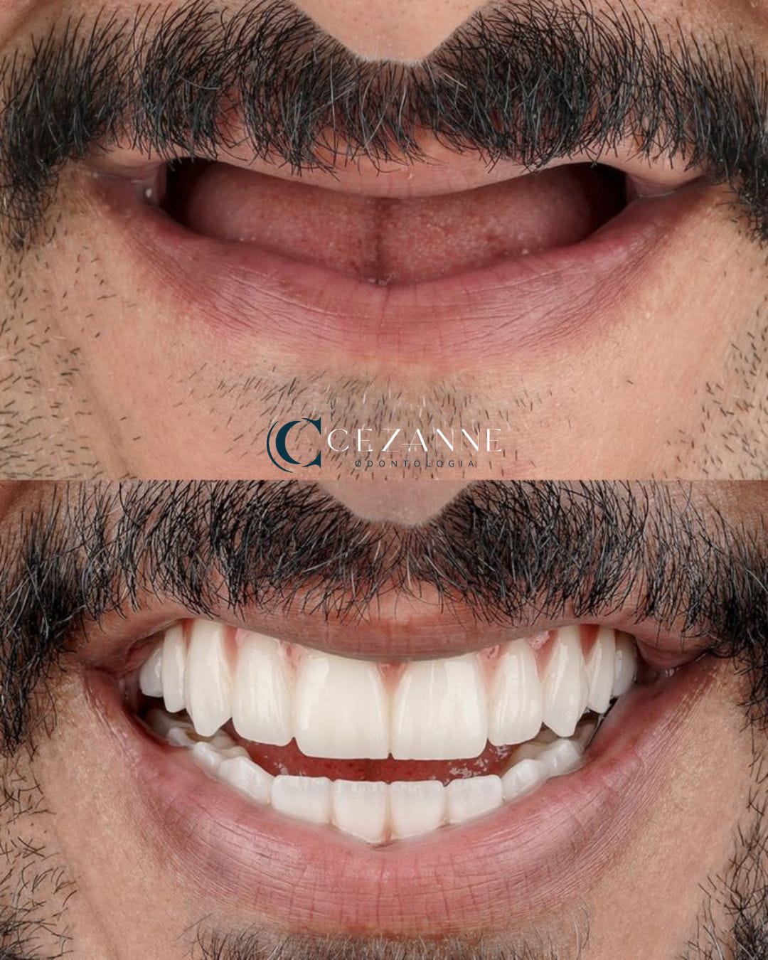 Caso clínico de implante dentário 6