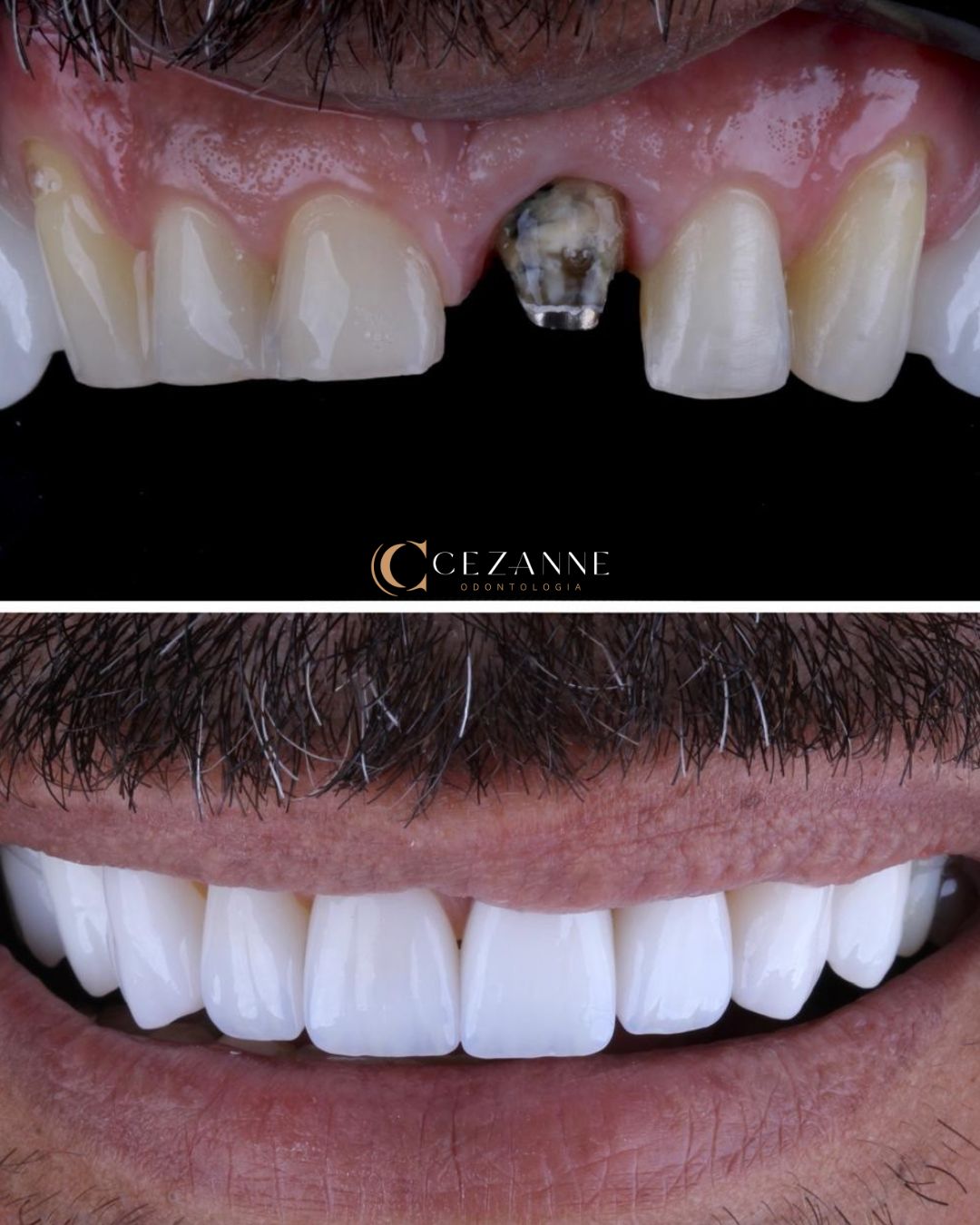 Caso clínico de implante dentário 1