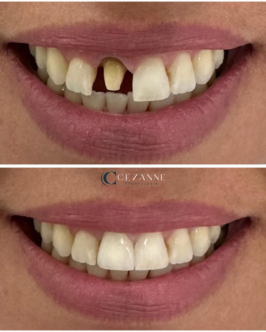 Caso clínico de implante dentário 3