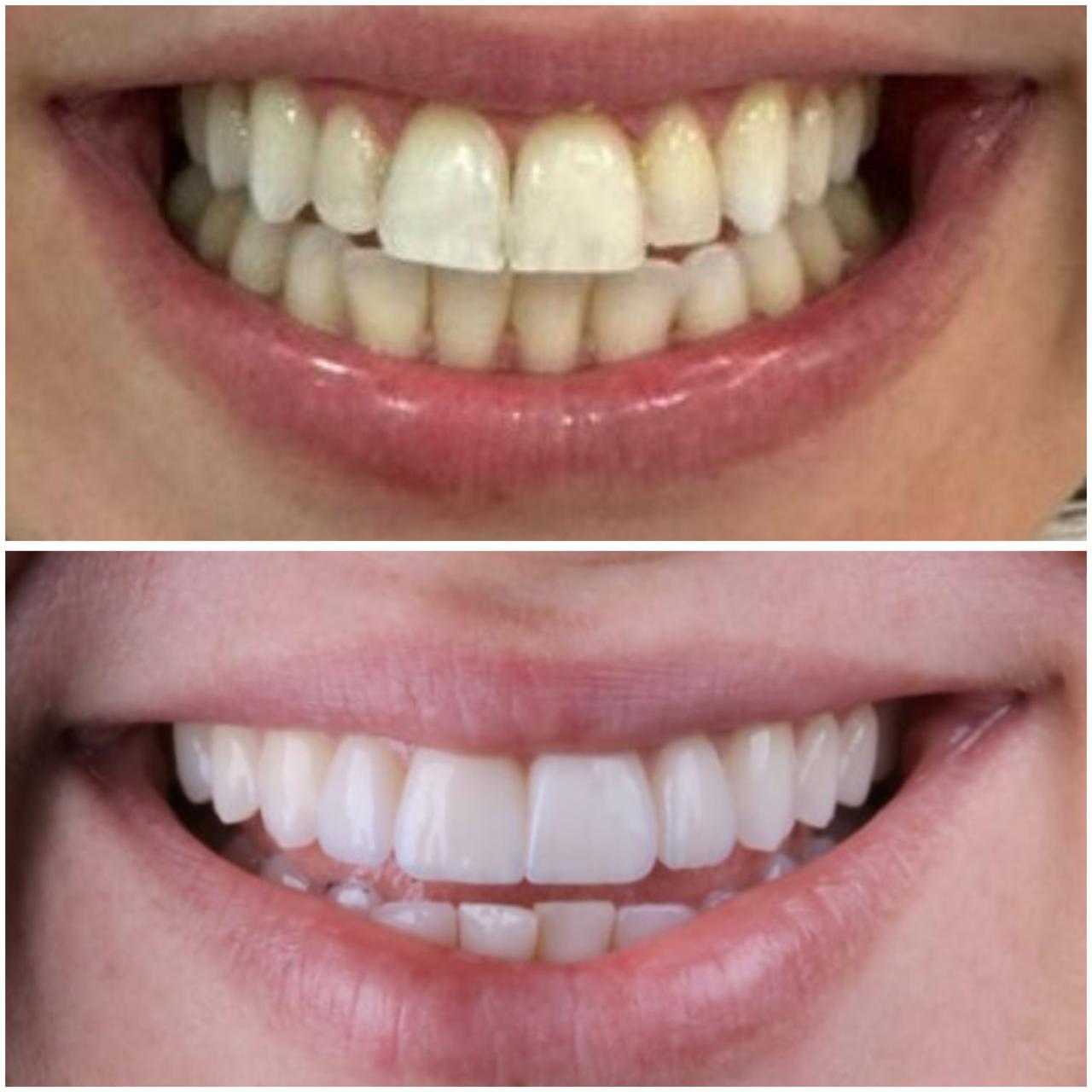 Caso clínico de implante dentário 2