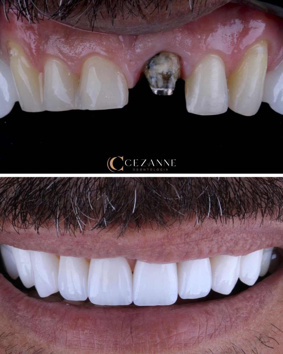Caso clínico de implante dentário 1