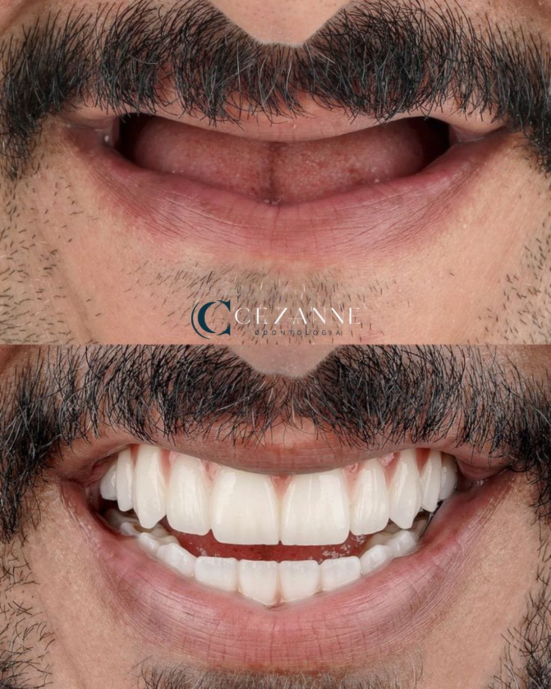 Caso clínico de implante dentário 6